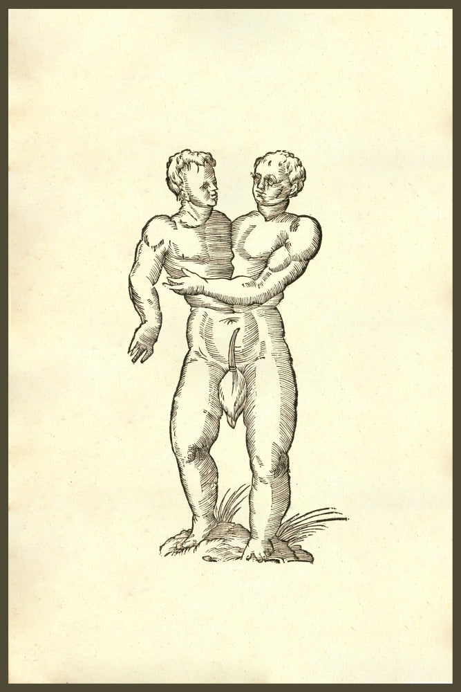 Infans Biceps Obscaeno Membro Siamese Twins Poster Print by Ulisse Aldrovandi