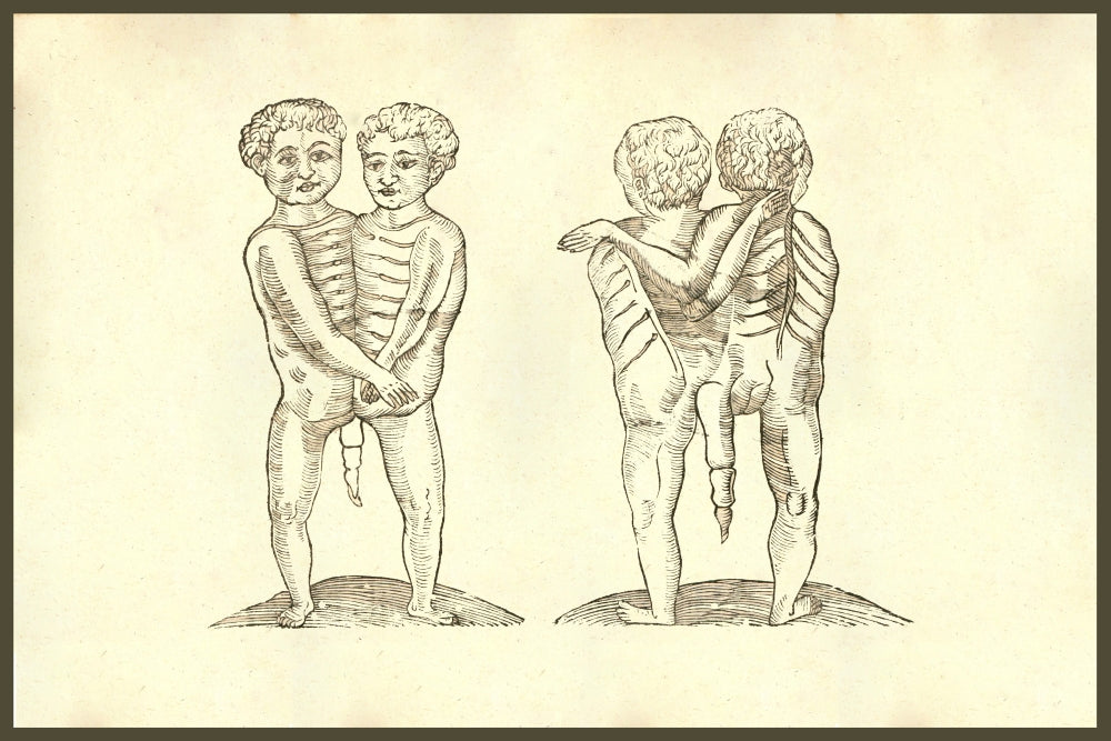 Monstrum Biceps Caudatum Prone & Supine Pictum Poster Print by Ulisse Aldrovandi