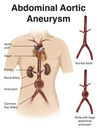 Abdominal Aortic Aneurysm Medical Poster Print by Alan Gesek, labeled anatomical illustration.