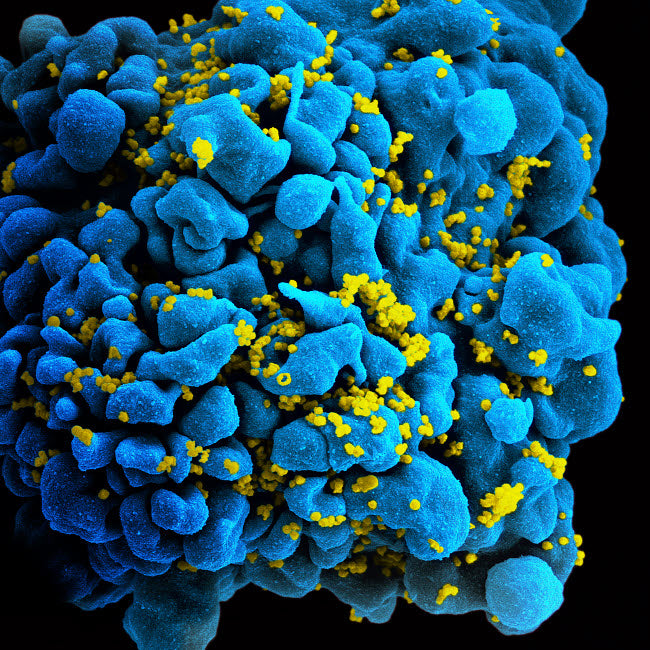 Colorized image of HIV-infected H9 T-cell poster print.