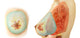 Medical illustration of female breast showing front and side views.