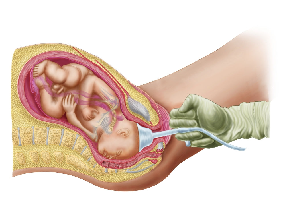 Medical illustration showing fetal delivery using vacuum extraction due to shoulder dystocia.
