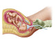 Medical illustration showing fetal delivery using vacuum extraction due to shoulder dystocia.
