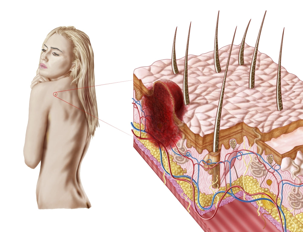 Atypical growth on skin illustration poster print for health awareness.