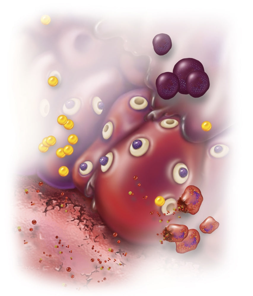 Surrounding Tissue Inflammation Poster Print by Stocktrek Images