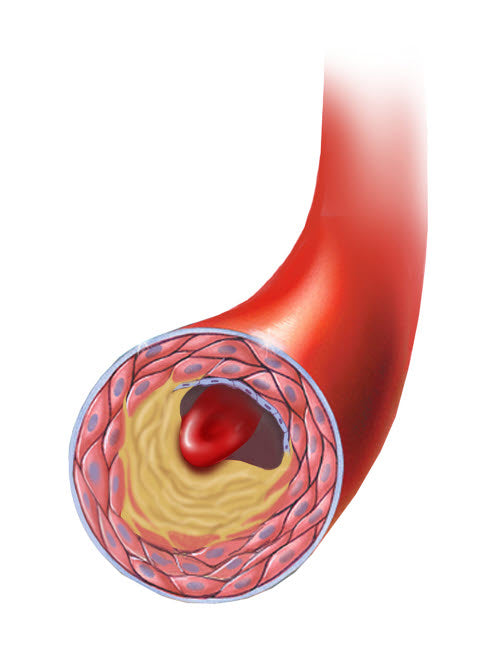 Normal Artery vs Plaque and Thrombus Formation Poster Print