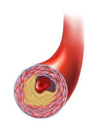 Normal Artery vs Plaque and Thrombus Formation Poster Print