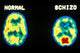PET Scans: Normal and Schizophrenic Poster Print featuring brain imaging.