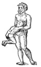 Parasitic Conjoined Twin 16th Century Poster Print, vintage anatomy art.
