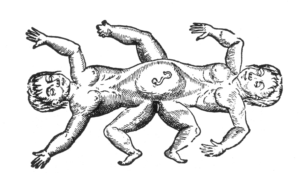 Ischiopagus Conjoined Twins 16th Century Poster Print on premium paper.
