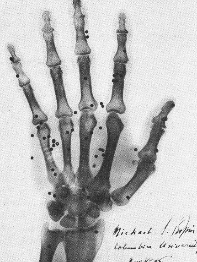 X-Ray of a Hand with Buckshot Poster Print showcasing details of human anatomy.