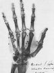 X-Ray of a Hand with Buckshot Poster Print showcasing details of human anatomy.