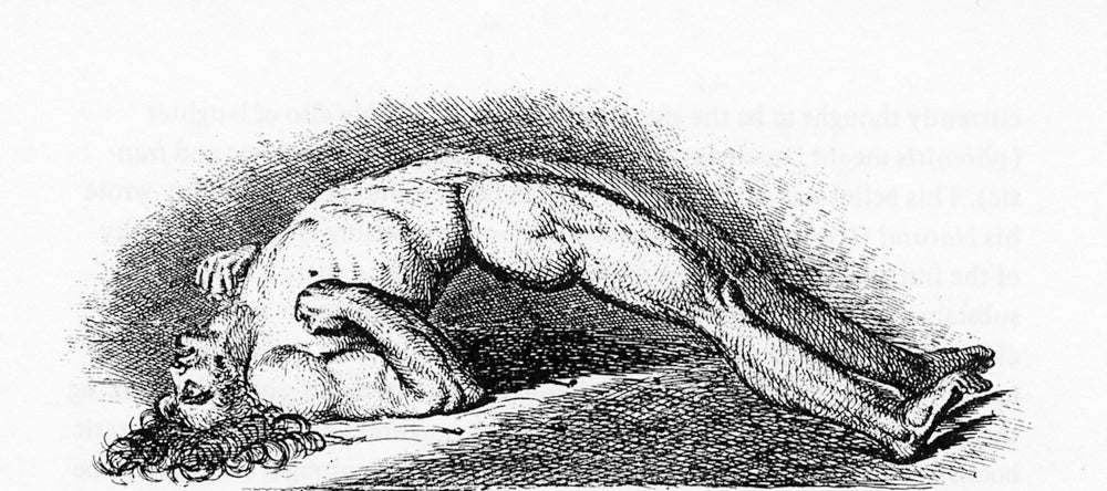 Opisthotonos Poster Print illustrating the hyperextension posture in neurology.