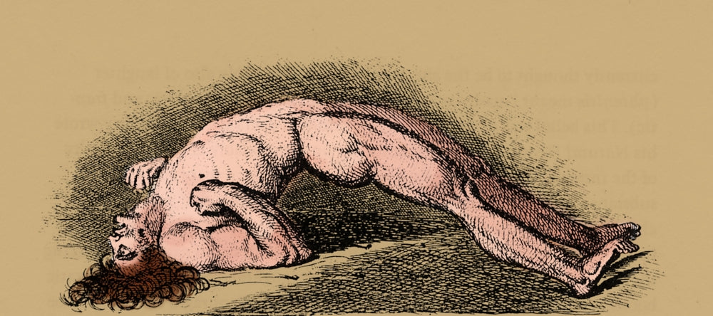 Opisthotonos Poster Print illustrating human anatomy