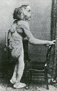 Joseph Merrick, The Elephant Man Fine Art Print - Science Source