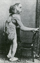 Joseph Merrick, The Elephant Man Fine Art Print - Science Source