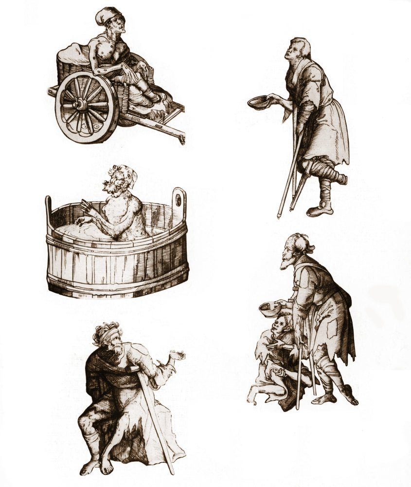 People With Leprosy Poster Print by Science Source, educational artwork.