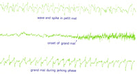 EEG of Epileptic Seizures Poster Print showcasing brain waveforms