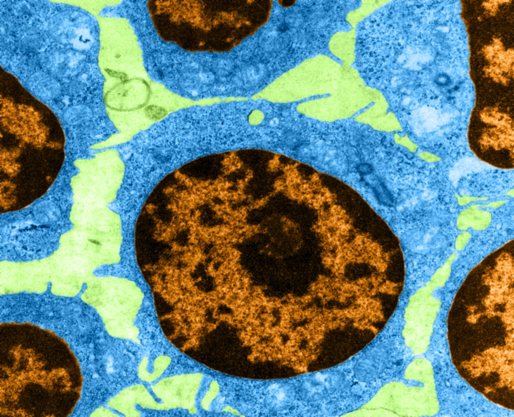 White Blood Cells in Leukemia Poster Print showcasing cellular biology