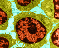 White Blood Cells in Leukemia (TEM) Poster Print showcasing detailed microscope image.