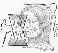 Paré Suture 1500s Poster Print showcasing historical surgical techniques.