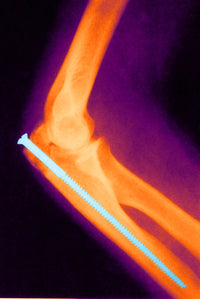 Broken Arm with Metal Pin X-Ray Poster Print showing detailed anatomy.