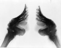 X-Ray of Bound Feet Poster Print showcasing foot binding practices