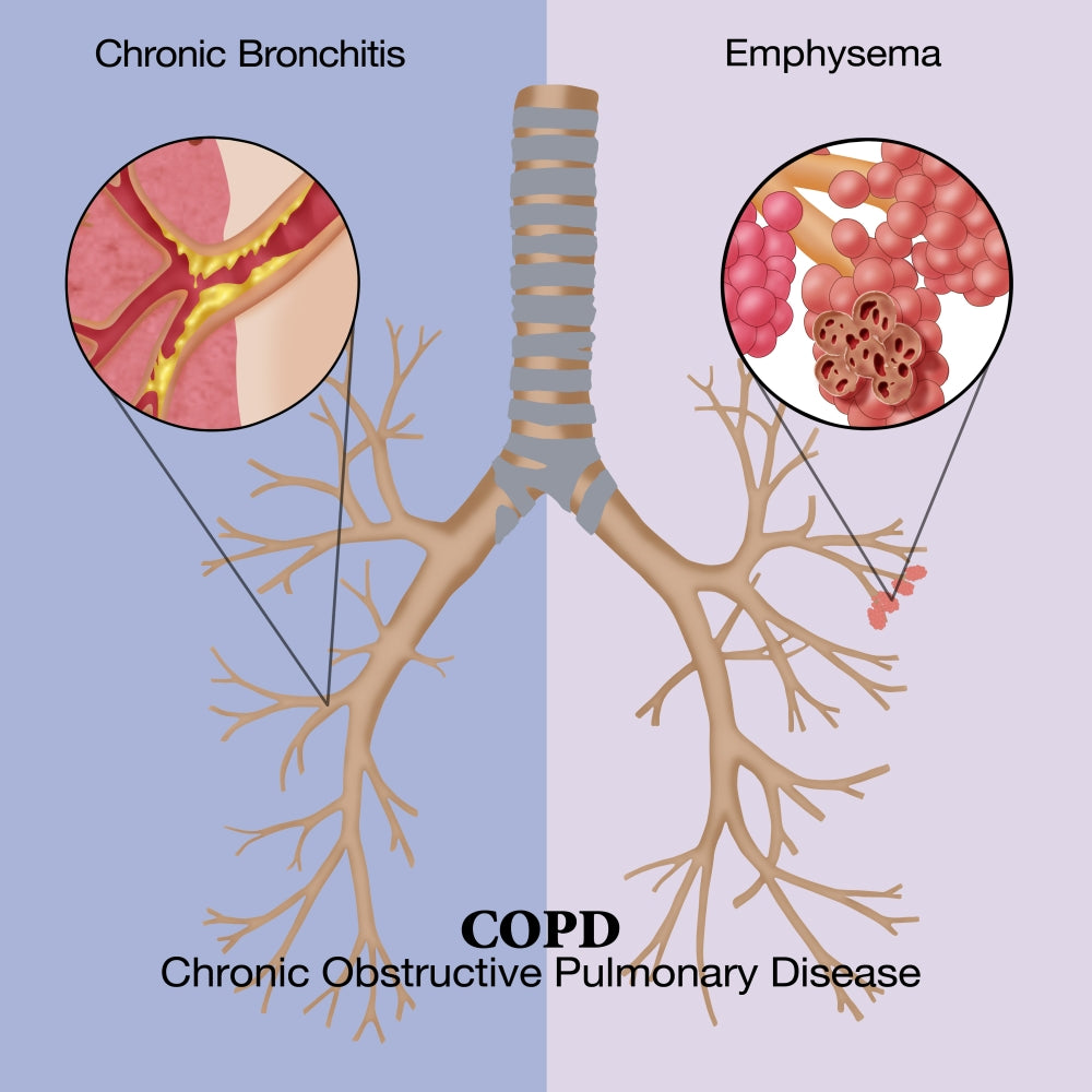 Chronic Obstructive Pulmonary Disease (COPD) educational poster print.