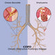Chronic Obstructive Pulmonary Disease (COPD) educational poster print.