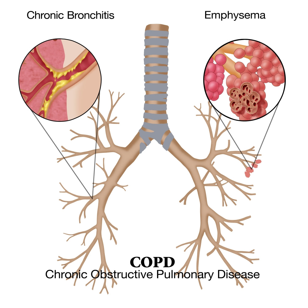 Chronic Obstructive Pulmonary Disease (COPD) Educational Poster Print by Monica Schroeder.