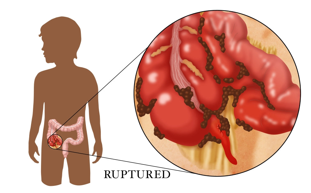 Ruptured Appendix Poster Print showcasing human anatomy by Monica Schroeder.