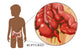 Ruptured Appendix Poster Print showcasing human anatomy by Monica Schroeder.