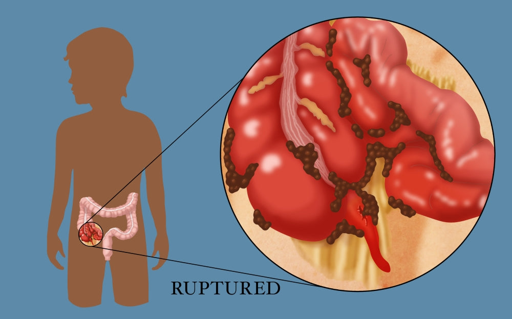 Ruptured Appendix Poster Print by Monica Schroeder, detailed anatomical illustration