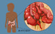 Ruptured Appendix Poster Print by Monica Schroeder, detailed anatomical illustration