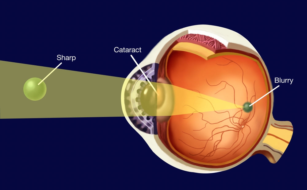 Cataract educational poster print illustrating human eye anatomy.