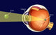 Cataract educational poster print illustrating human eye anatomy.