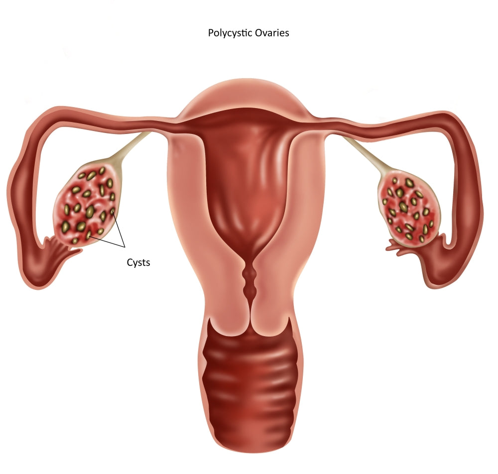 Polycystic Ovaries Educational Poster Print showcasing reproductive health.