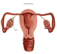 Polycystic Ovaries Educational Poster Print showcasing reproductive health.
