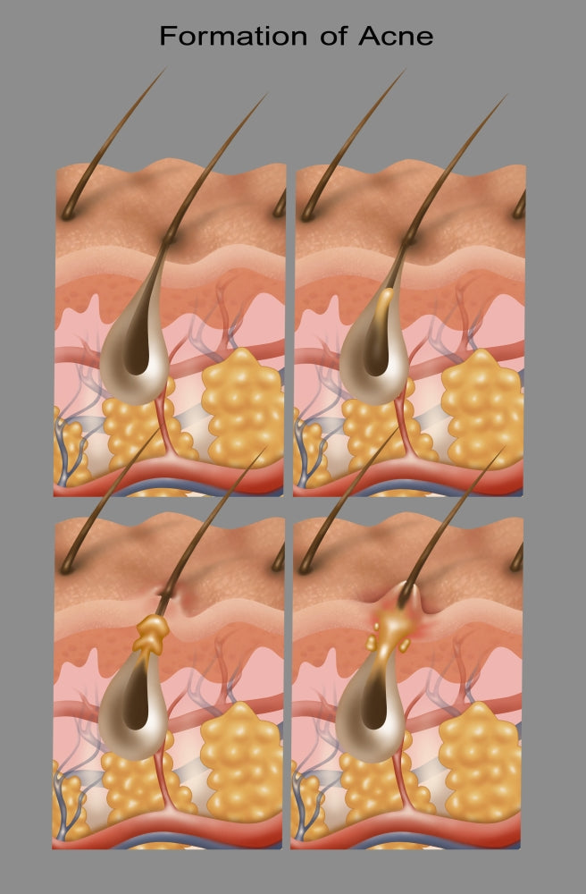Acne Educational Poster Print by Gwen Shockey - Science Source