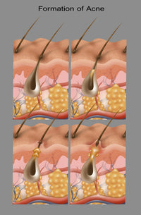 Acne Educational Poster Print by Gwen Shockey - Science Source