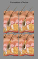 Acne Educational Poster Print by Gwen Shockey - Science Source