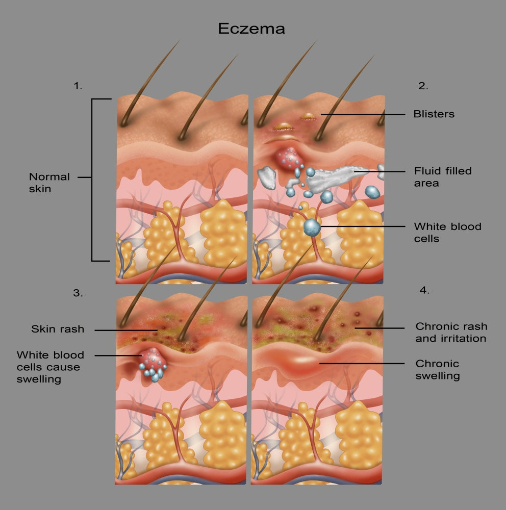 Eczema Awareness Poster Print by Science Source, showcasing vital skin health information.