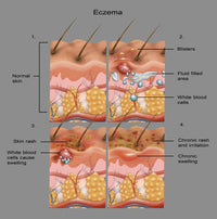 Eczema Awareness Poster Print by Science Source, showcasing vital skin health information.