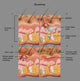 Eczema Awareness Poster Print by Science Source, showcasing vital skin health information.