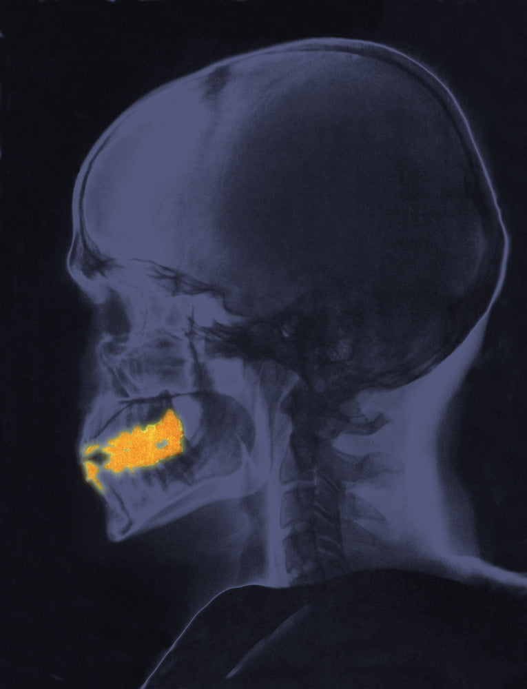 Skull X-Ray with Dental Fillings Poster Print showcasing intricate details.