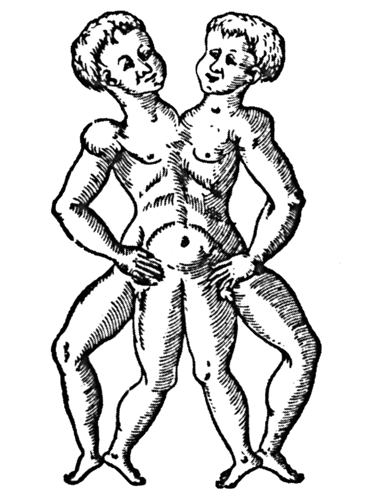 Conjoined Twins 16th Century Poster Print by Science Source