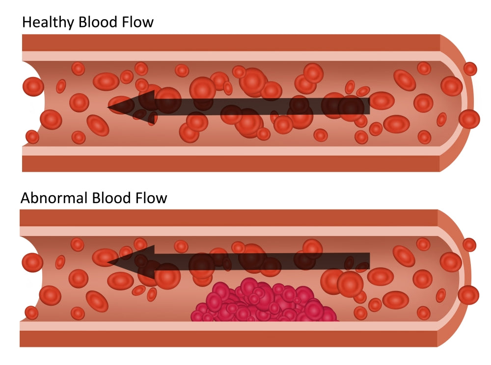 Healthy and Abnormal Blood Flow Educational Poster Print