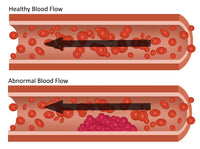 Healthy and Abnormal Blood Flow Educational Poster Print
