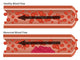 Healthy and Abnormal Blood Flow Educational Poster Print