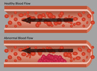 Healthy and Abnormal Blood Flow Educational Poster Print
